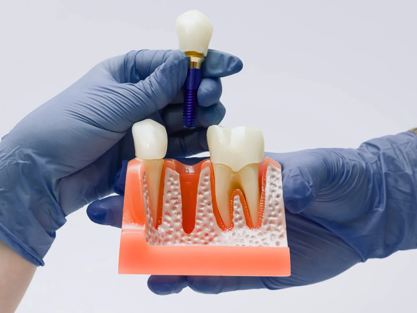 Implant dentar sau proteză mobilă: ce variantă este mai stabilă pe termen lung?