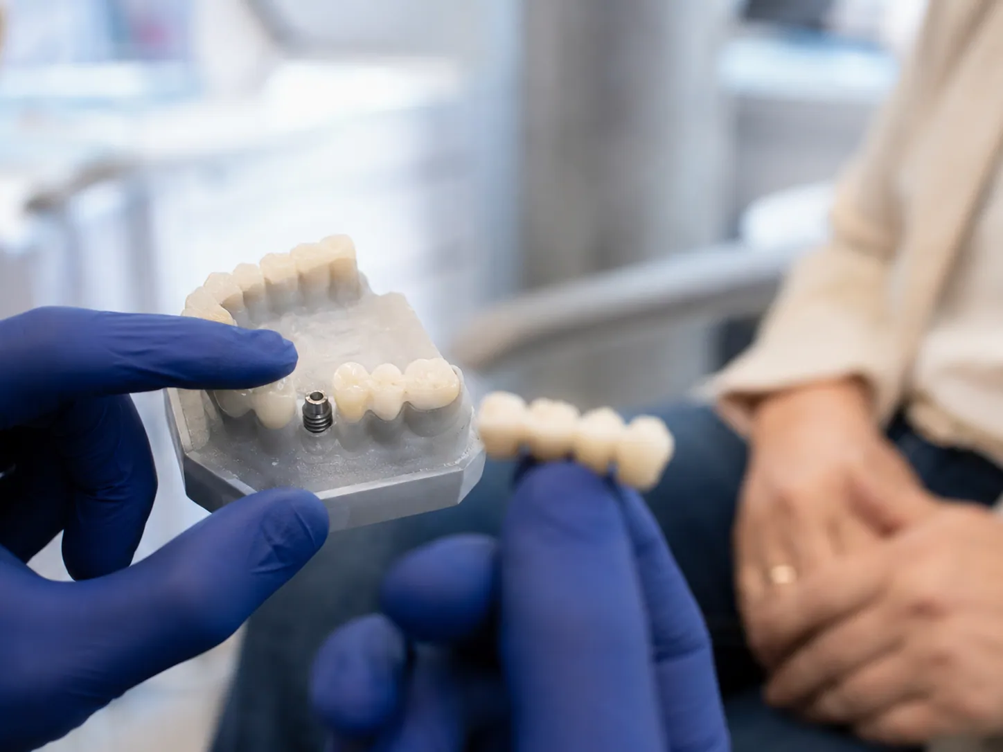 Punte dentară sau implant dentar: ce alegi când îți lipsește un dinte?