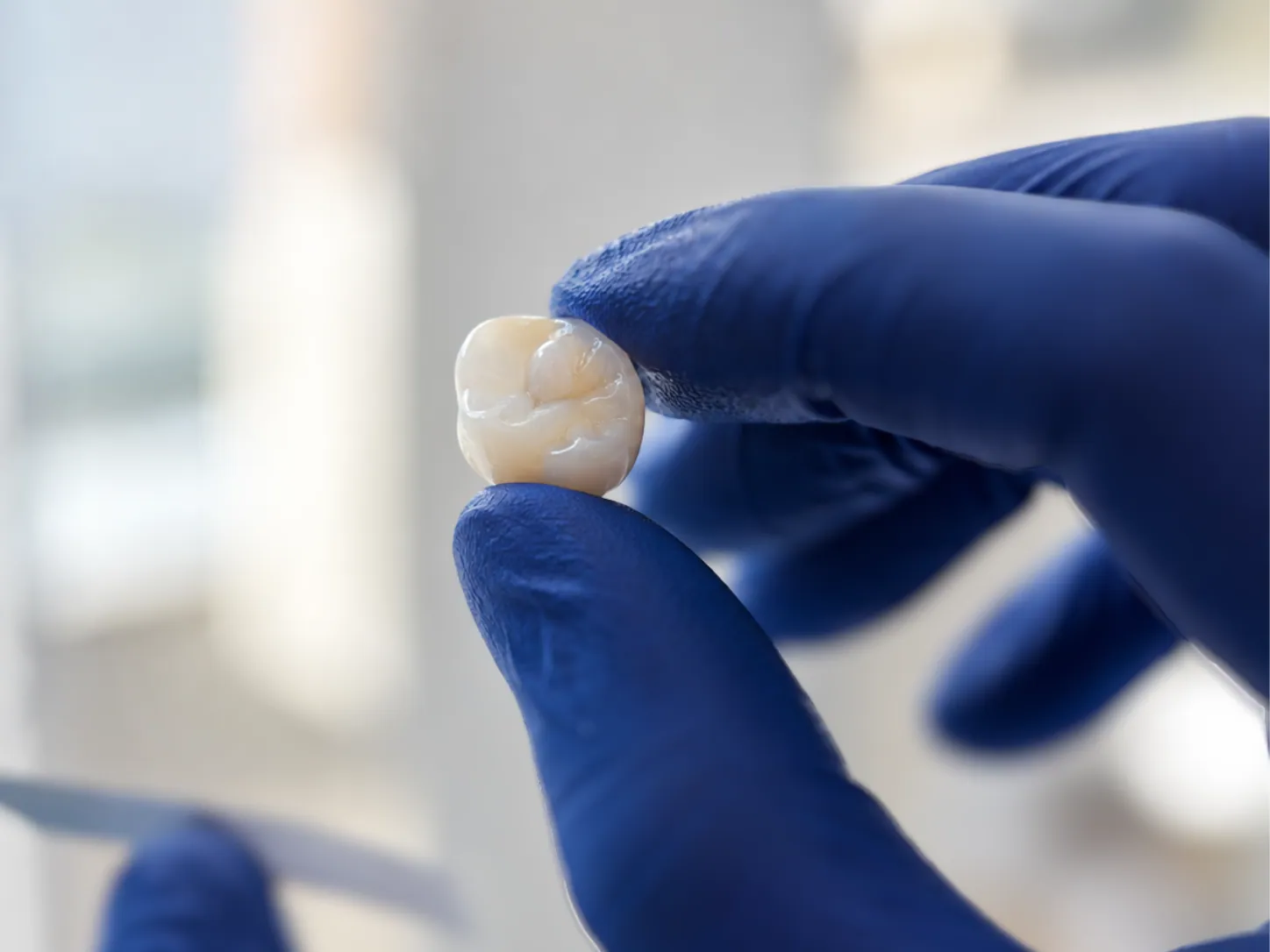 Cât rezistă o coroană dentară pe zirconiu și ce îi influențează durata de viață?