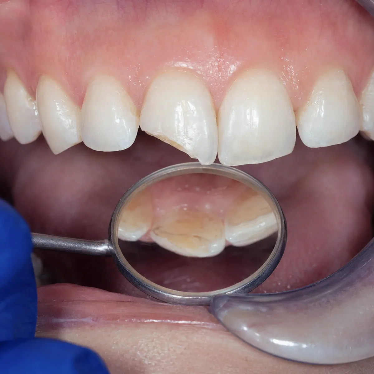 Carie profundă - indicație pentru tratament endodontic